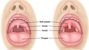 Một bệnh nhân tử vong do bệnh bạch hầu ở Đác Lắc