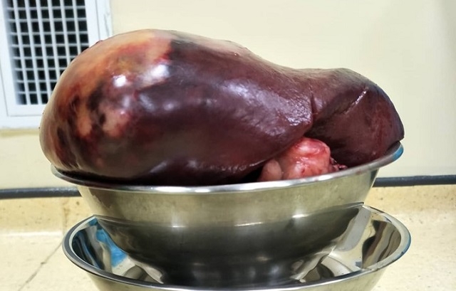 Khối u lách nặng 2,3 kg.