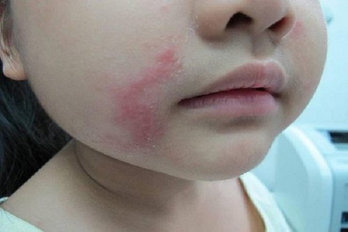 Tiếp xúc với kiến ba khoang có thể bị nhiễm độc, gây tổn thương da