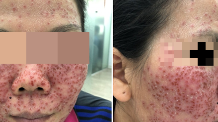 Hiểm họa làm đẹp bằng sản phẩm lột da