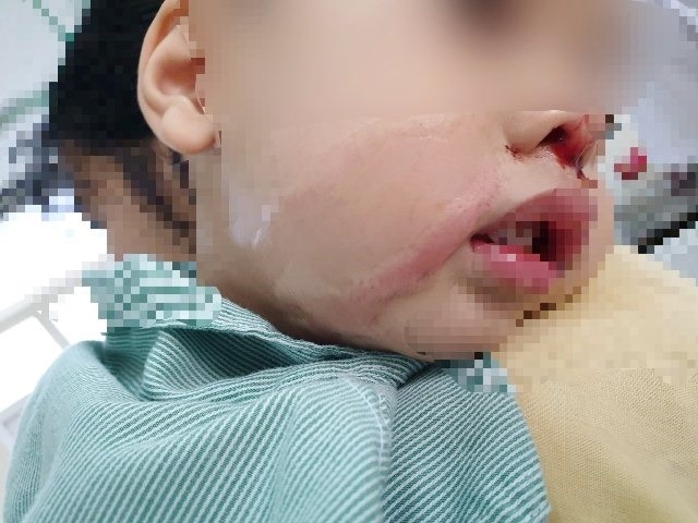 Hình ảnh tổn thương của bệnh nhi.
