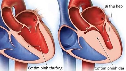 Chuyên gia bác bỏ khả năng lây lan vi-rút lạ gây ra viêm cơ tim