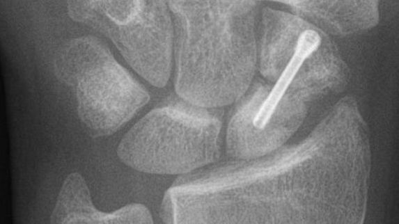 Herbert screws