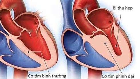 Bộ Y tế chưa ghi nhận chủng virus "mới lạ" gây viêm cơ tim