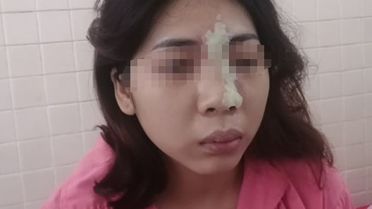 Mù mắt sau khi tiêm filler nâng mũi tại spa