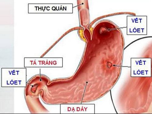 Nhựa cây sung chữa đau dạ dày.