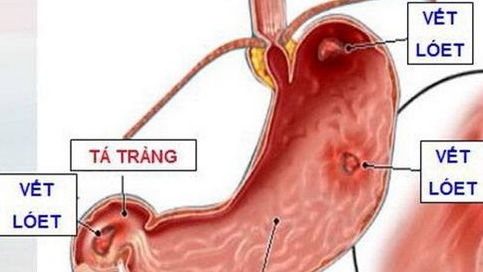 Nhựa cây - Vị thuốc chữa nhiều bệnh