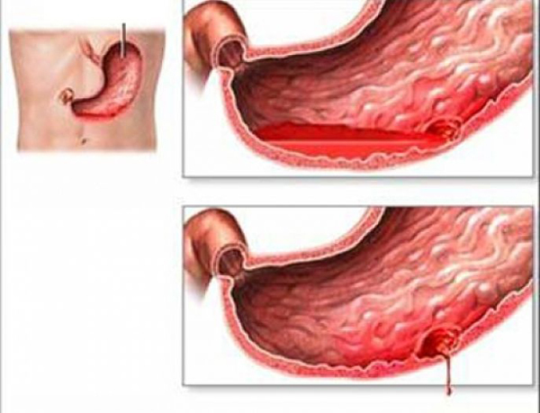 Hình ảnh mô phỏng nội soi xuất huyết dạ dày