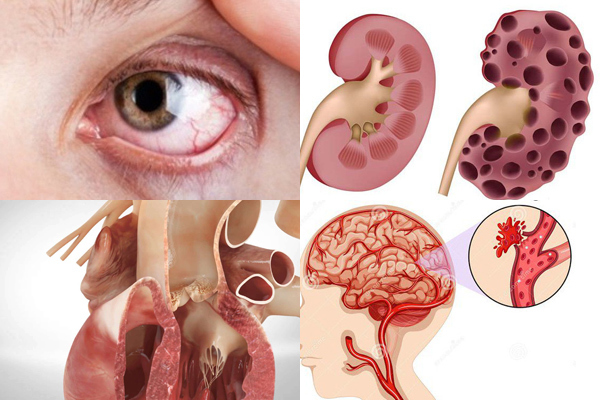 Các biến chứng hay gặp nhất của tăng huyết áp là đột quỵ, suy tim, suy thận, tổn thương đáy mắt, tách thành động mạch chủ