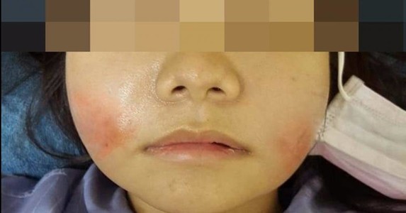 Cô gái mặt phồng như trái bóng do tiêm filler làm đẹp