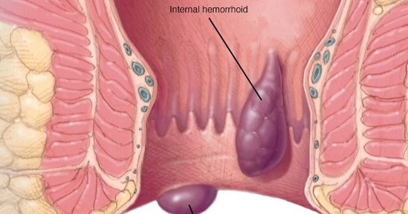 Bệnh trĩ ngày càng có nhiều người mắc, dấu hiệu nhận biết bệnh sớm nhất