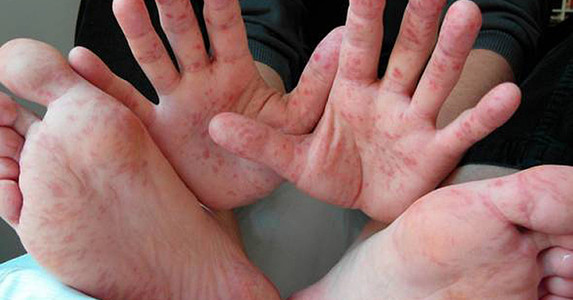 Nguy cơ bệnh tay chân miệng do không rửa tay sạch
