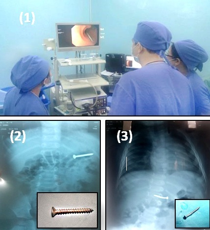 Hình ảnh nội soi và dị vật là 2 thanh đinh được gắp ra khỏi bụng 2 bệnh nhi. Ảnh:BSCC