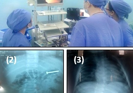 Bệnh viện cùng lúc cấp cứu 2 bệnh nhi nuốt đinh suýt thủng ruột non