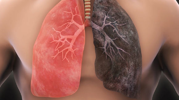 Mắc ung thư phổi sống được bao lâu?