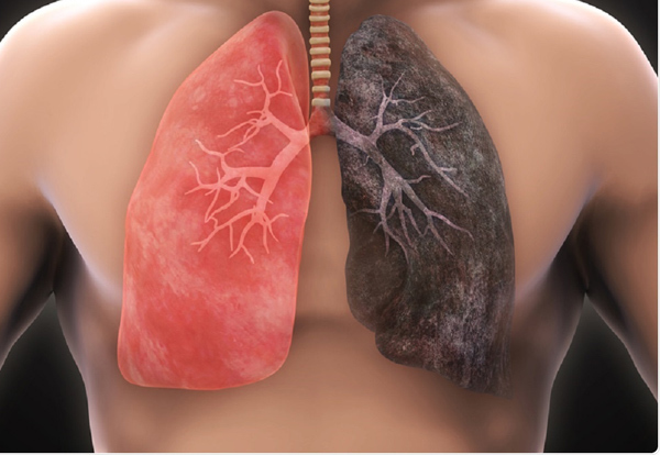 Ung thư phổi là một trong những ung thư diễn tiến nhanh, tỉ lệ tử vong lớn do việc phát hiện sớm gặp nhiều khó khăn