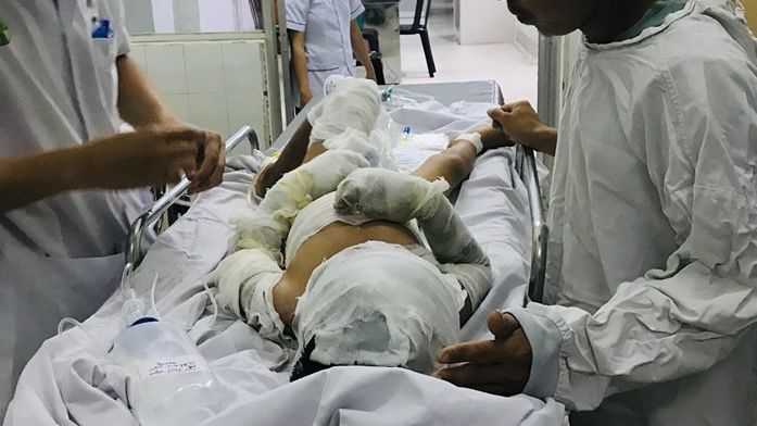Điều trị tâm lý cho bé trai 6 tuổi bị dì tẩm xăng đốt