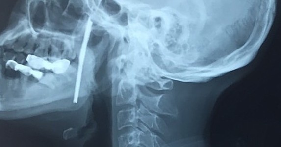 Phẫu thuật rút thanh sắt đâm xuyên cổ người thợ