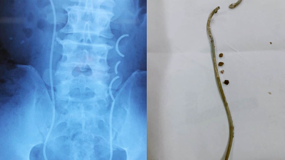 Người đàn ông bỏ quên ống thông trong người 3 năm
