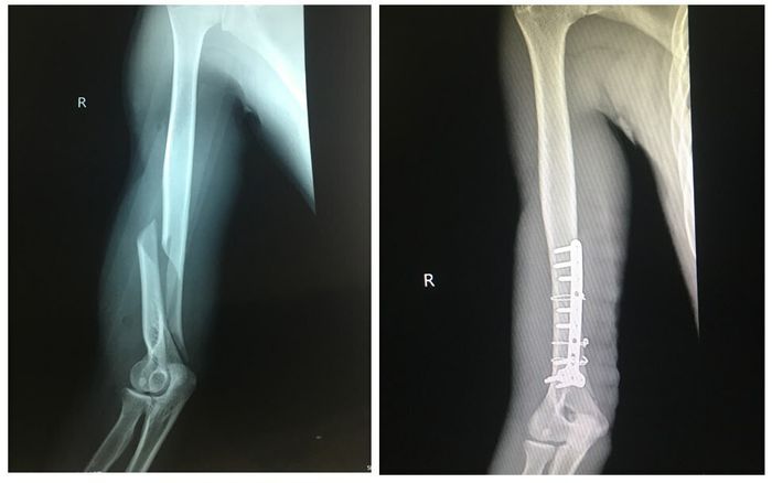 Gãy xương do chơi vật tay