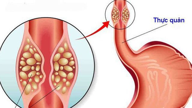 Cứu người ung thư gan bị vỡ thực quản