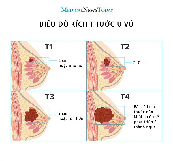 Xác định giai đoạn ung thư vú qua kích thước khối u