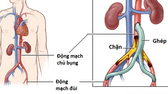 Bé 8 tuổi ghép động mạch chủ từ người cho chết não