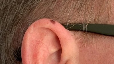 Người đàn ông phải cắt một phần tai khi phát hiện chấm đổi màu trên da