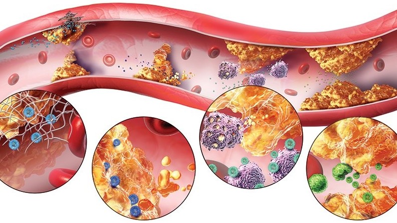 Liệu pháp điều chỉnh rối loạn lipid máu ở bệnh nhân mắc bệnh thận mạn