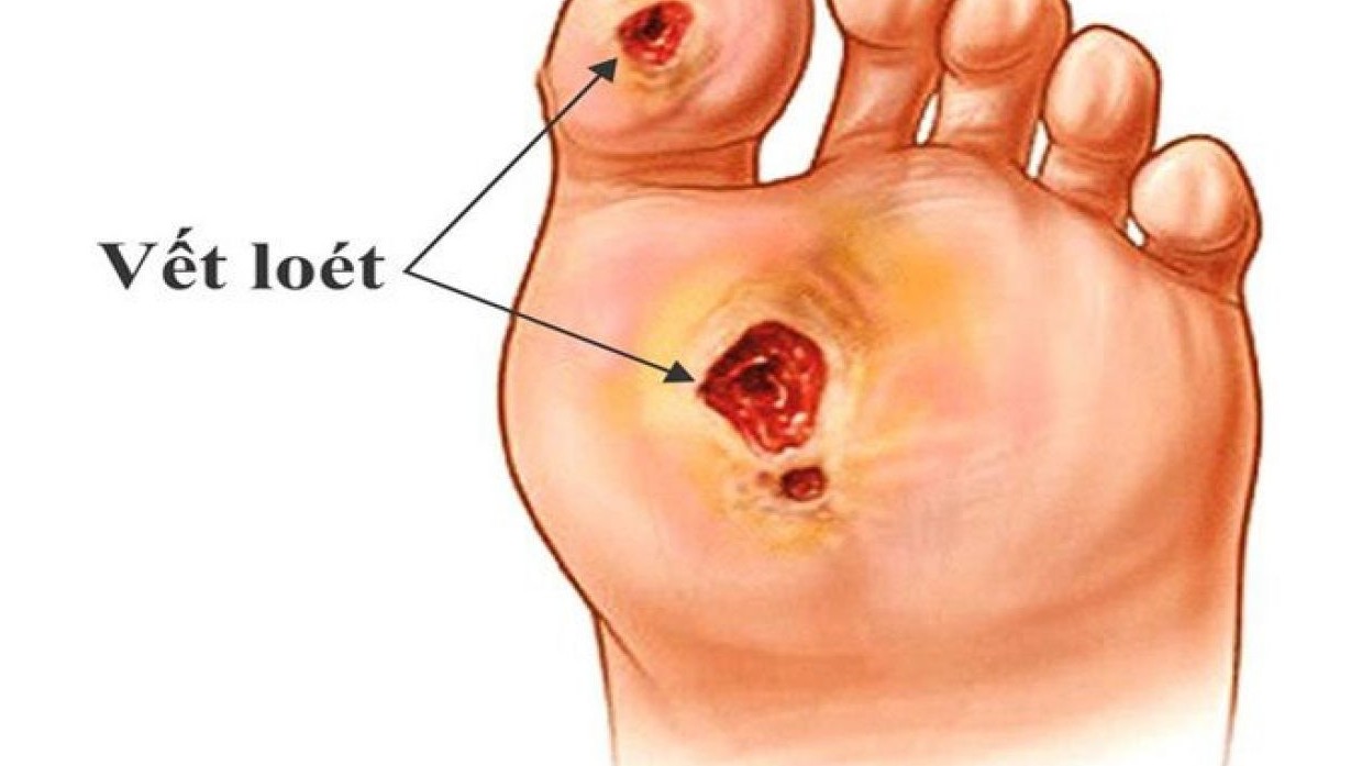 Chăm sóc vết thương ở bàn chân khi bị bệnh đái tháo đường