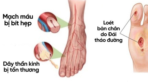 Bệnh thần kinh đái tháo đường