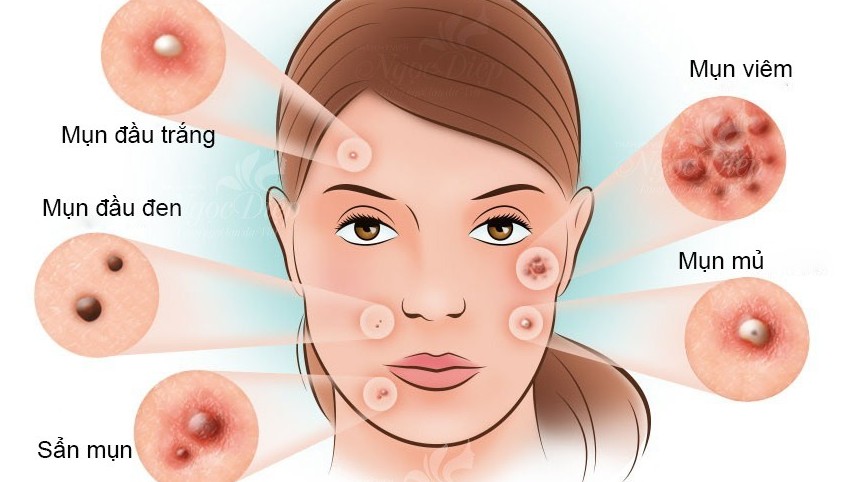 Vai trò của chăm sóc da trong tối ưu hóa điều trị mụn trứng cá và bệnh Rosacea