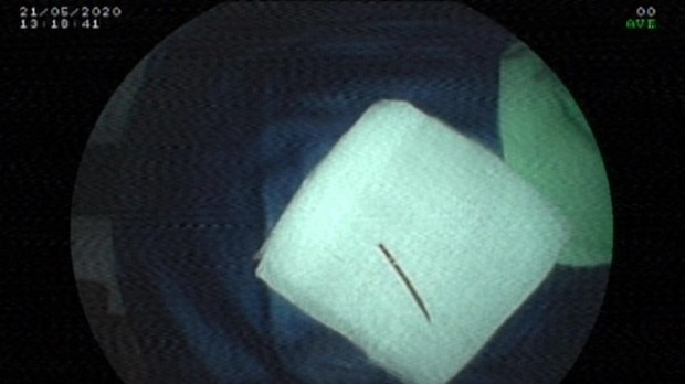 Doctors remove toothpick from female patient's anus