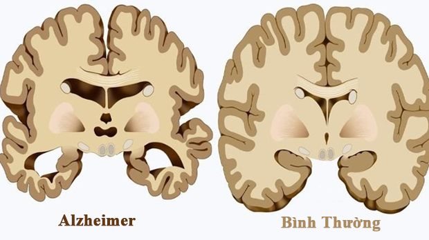 Thuốc mới với nhiều hứa hẹn trong điều trị Alzheimer