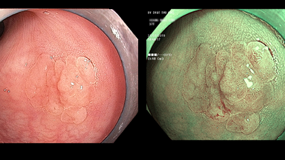 Nguy cơ ung thư từ polyp đại tràng