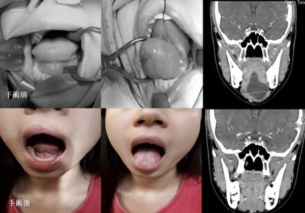 Nữ sinh giao tiếp khó khăn và chịu đựng đau đớn do bị bệnh nang nhái sàn miệng