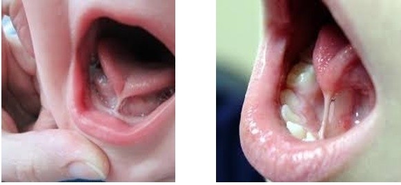 Không phải cứ trẻ chậm nói là mắc chứng tự kỷ