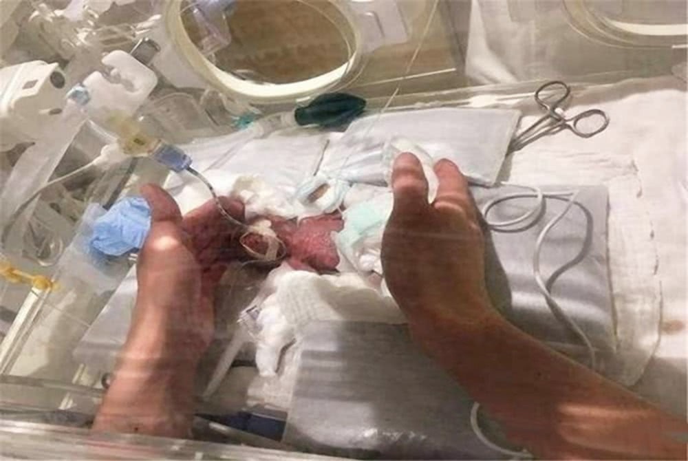 Bất ngờ hình ảnh sau 14 năm của cô bé nhỏ nhất thế giới sinh ra chỉ 260gr
