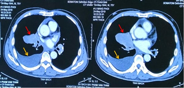 Hút thuốc 25 năm, người đàn ông mắc 2 ung thư cùng lúc di căn não