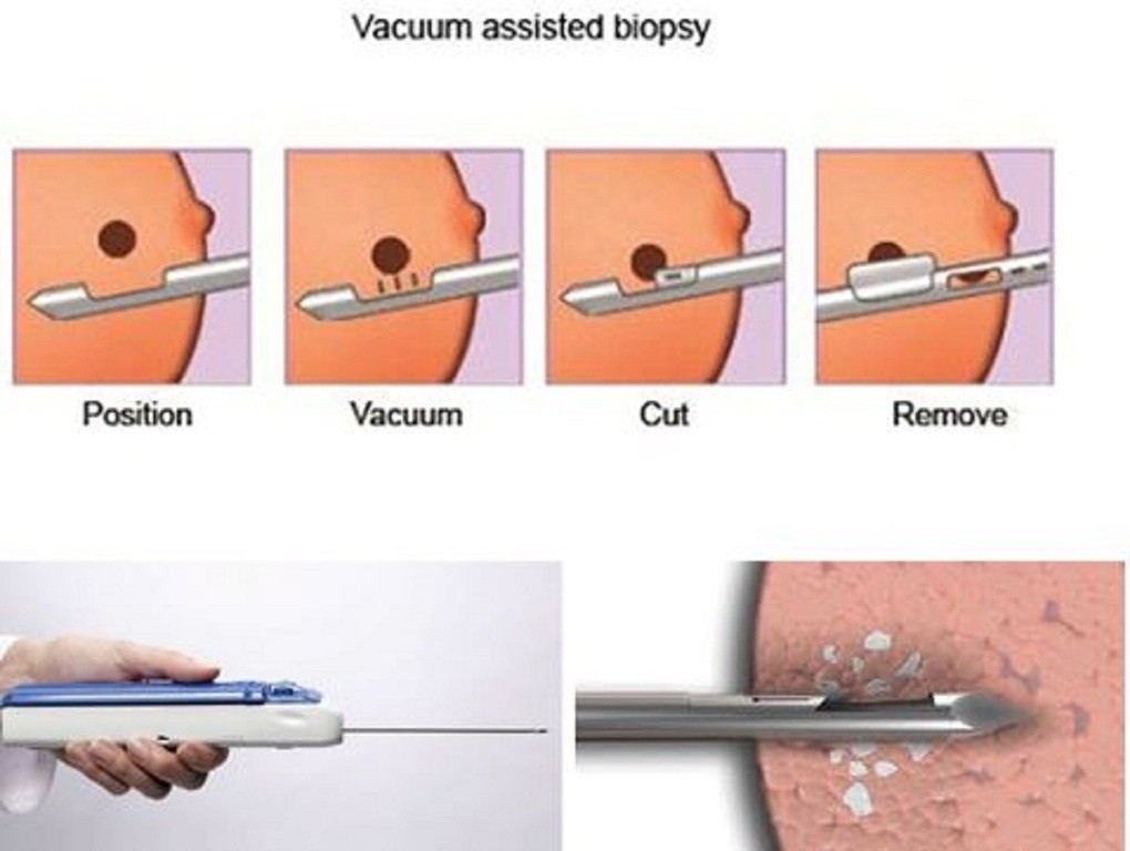 Sinh thiết hút chân không chữa ung thư vú