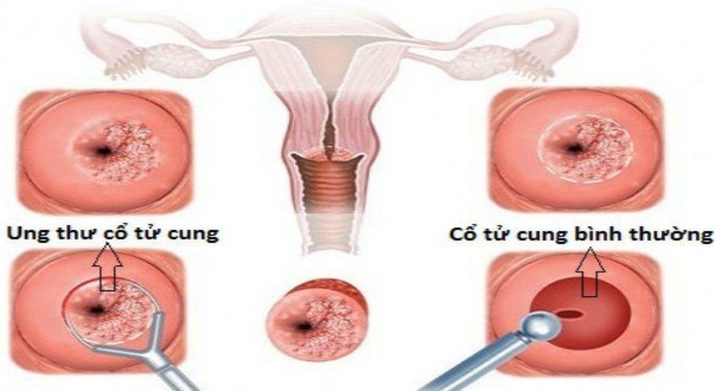 Ung thư cổ tử cung vẫn có thể sinh con