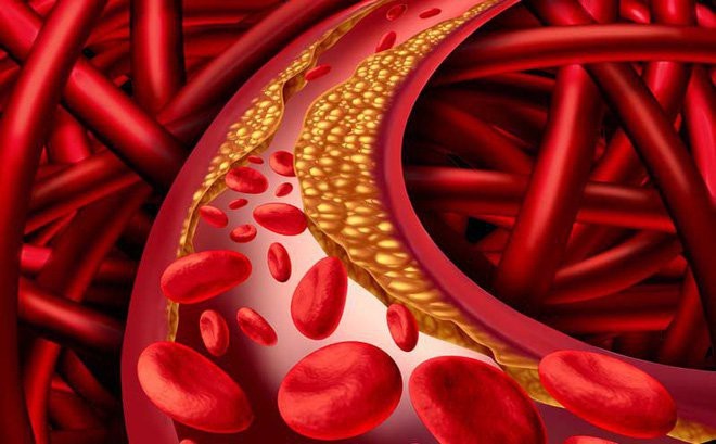 Nửa triệu người Việt bị tăng cholesterol do di truyền