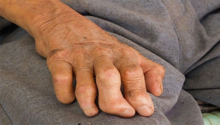 Bàn tay của người mắc bệnh phong. Ảnh: MedSIT.