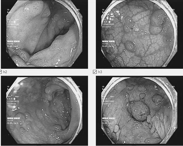 Hơn 100 polyp trong ruột người phụ nữ