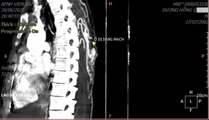 Ảnh chụp cắt lớp ổ dị dạng động tĩnh mạch ẩn dưới da của bệnh nhân. Ảnh: Bệnh viện cung cấp.