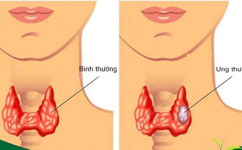 Ung thư tuyến giáp có điều trị dứt điểm được không?