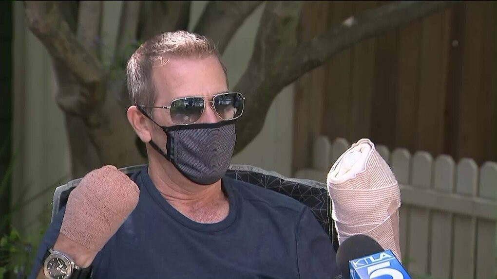 Gregg Garfield, 54 tuổi, trả lời phỏng vấn của kênh KTLA5 sau khi đã cắt bỏ các ngón tay. Ảnh: KTLA5