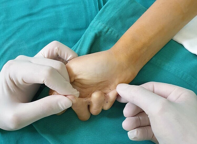Mổ tách ngón tay dính chặt của thiếu nữ