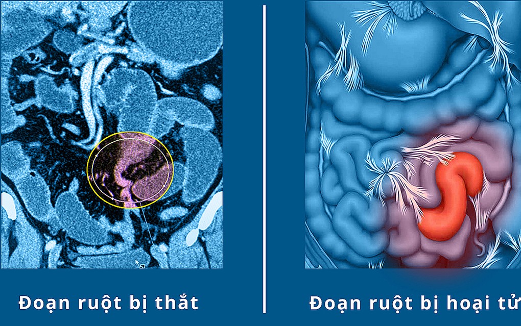 Hoại tử ruột suýt chết