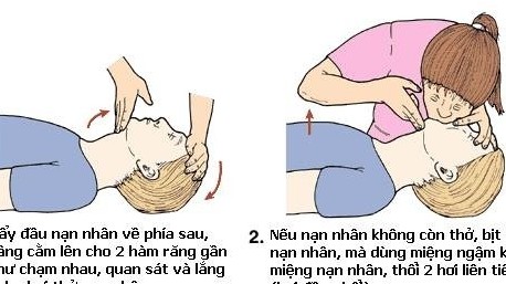 Xử trí đúng cách khi gặp nạn gây đứt chi